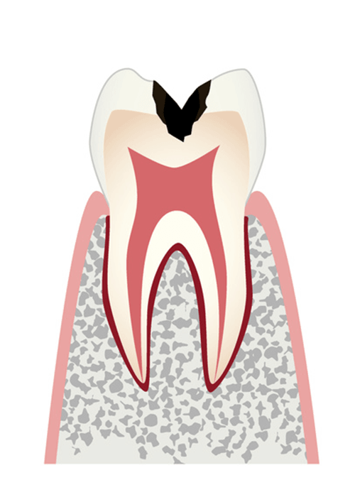 歯の内部の象牙質まで拡大した状態