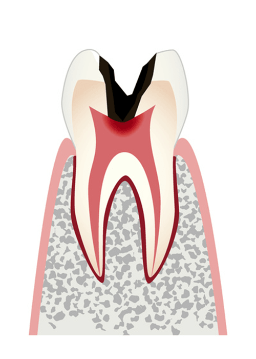 歯が大きく失われた状態